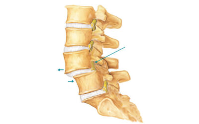 Spondylolisthesis: Causes, Symptoms, Diagnosis, and Treatment