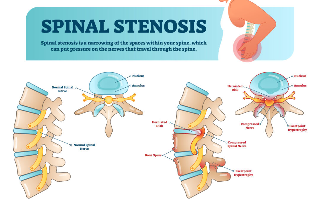 What Is Spinal Stenosis Dr Kayvan Haddadan Pain Medicine