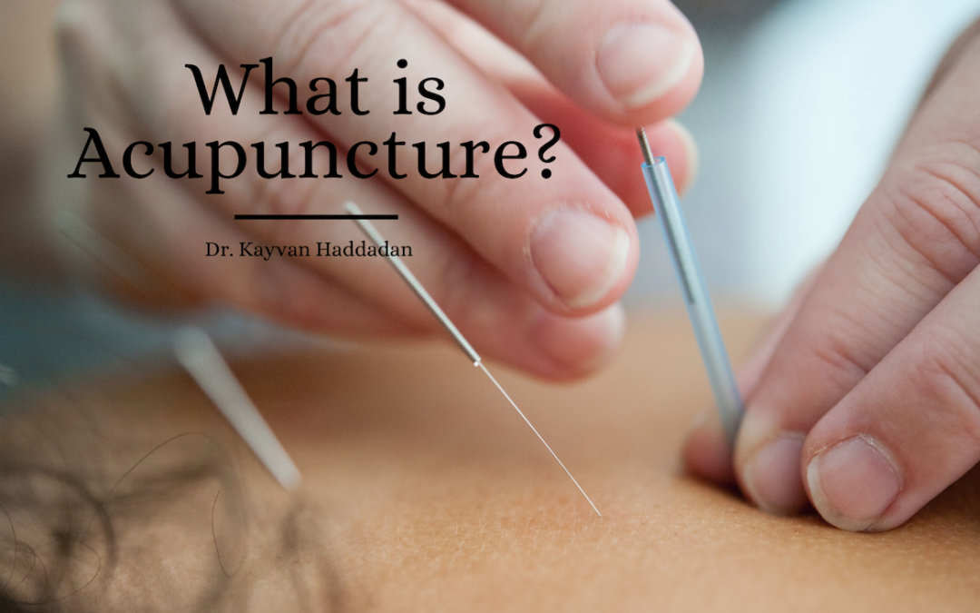Kh What Is Acupuncture (1)