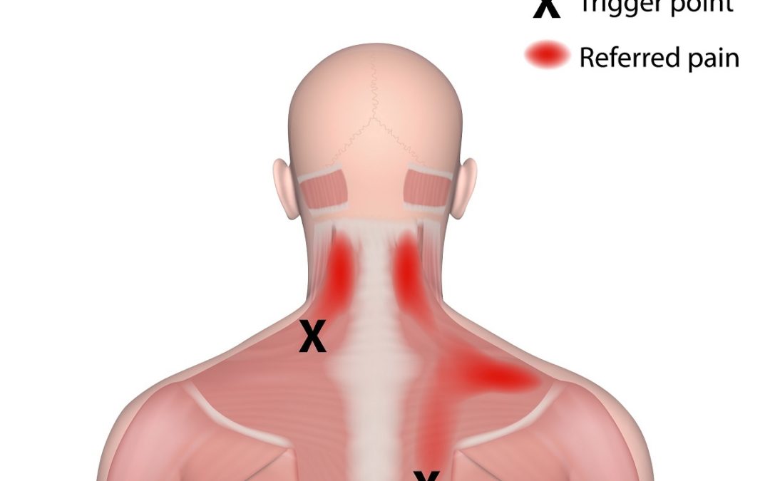 Trigger Points And Referred Pain