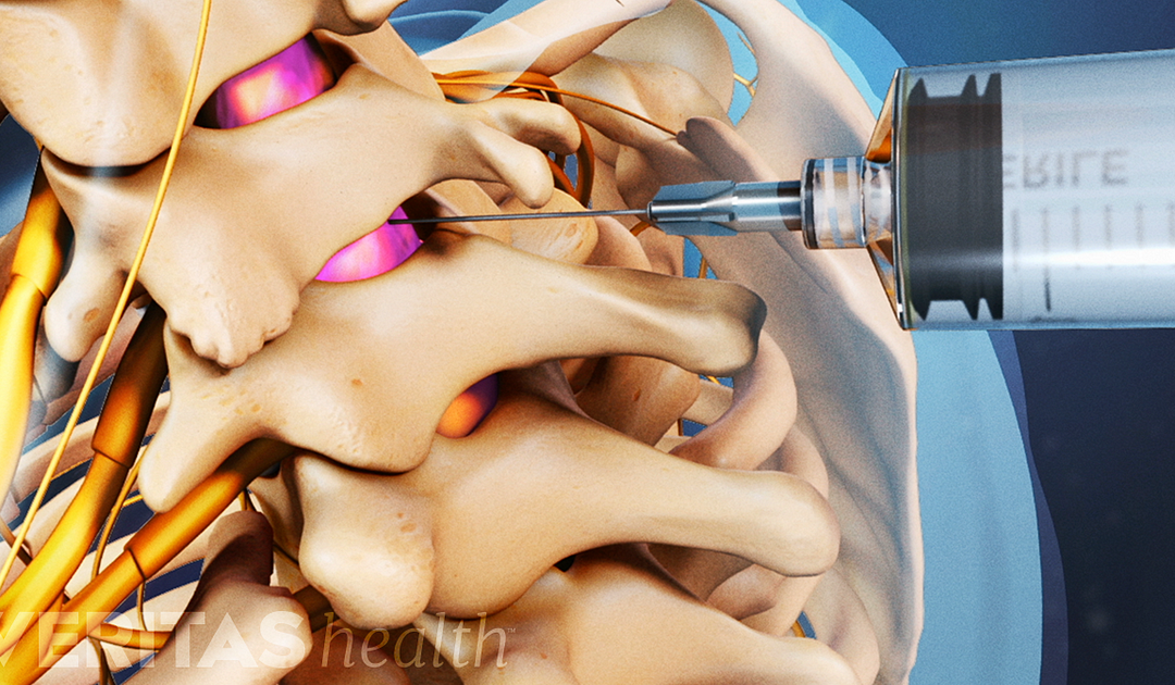 Cervical Epidural Steroid Injections Can Bring Neck And Arm Pain Relief Dr Kayvan Haddadan
